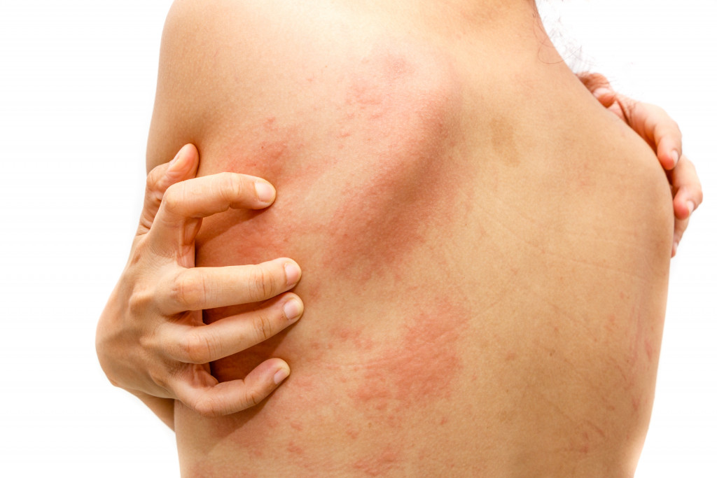 A person experiencing severe hives