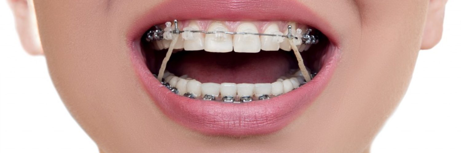 braces with rubber